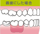  義歯にした場合