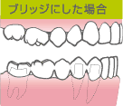 ブリッジにした場合