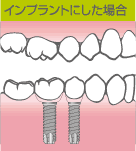 インプラントにした場合